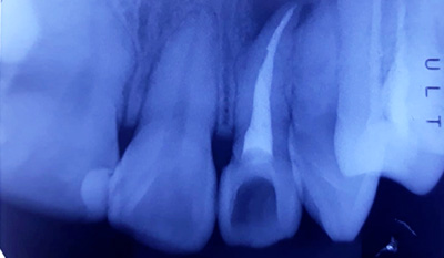 Endodoncia