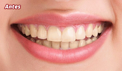 SmileKit® - Espuma blanqueadora Dental – kompraseguracolombia