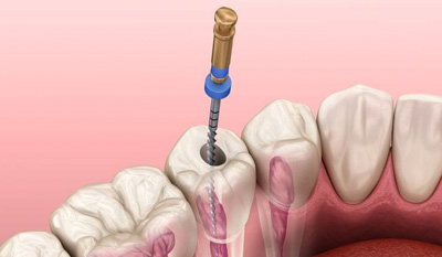 Endodoncia dental