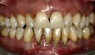 Periodontitis