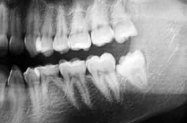 Extracción tercer molar