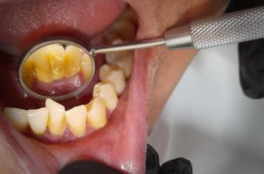 ¿Cómo prevenir la Gingivitis?