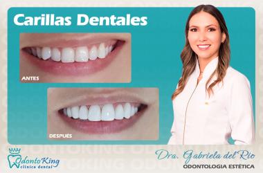 Recomendaciones para pacientes con carillas dentales