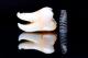 ¿De qué material son los implantes dentales?