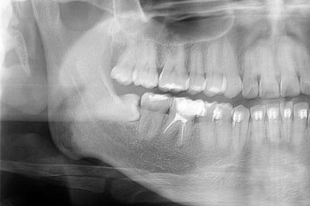 Extracción de tercer molar totalmente incluida